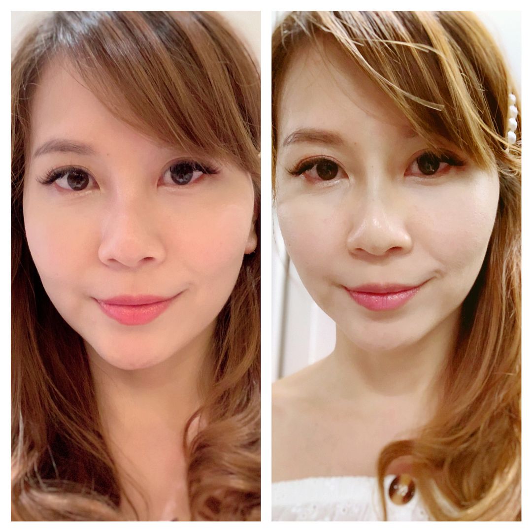 Ultra V HIKO Nose Thread Lift with The Clifford Clinic Regina Chow